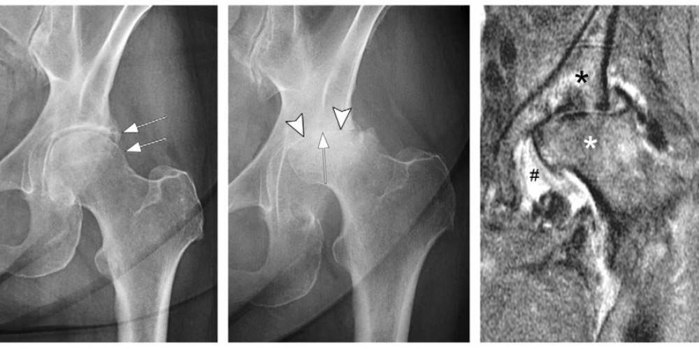 Treatment Options for Osteoarthritis